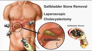 Gall Bladder Stone Ayurvedic Treatment